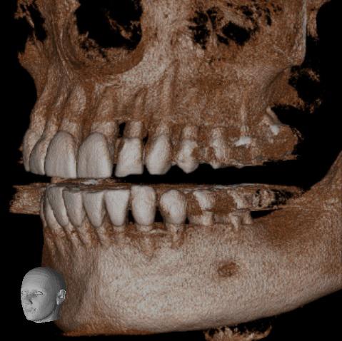 DVT-Untersuchung bei Zahnarzt Dr. Dilaver in Mainz - moderne Bildgebung in der integrativen Zahnmedizin